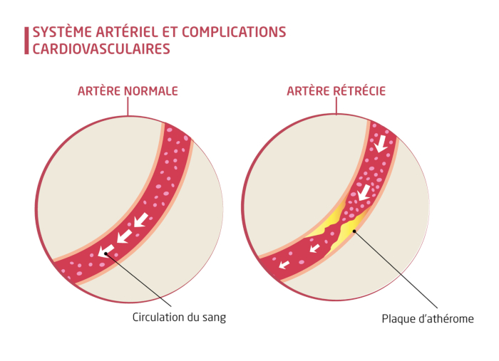 complications cardiovasculaires